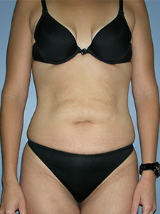 Tummy Tuck Before and After Pictures Miami, FL