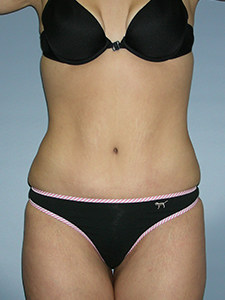 Tummy Tuck Before and After Pictures Miami, FL