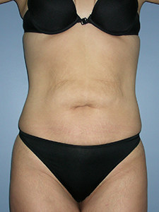 Tummy Tuck Before and After Pictures Miami, FL