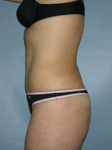 Tummy Tuck Before and After Pictures Miami, FL