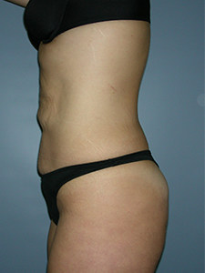 Tummy Tuck Before and After Pictures Miami, FL