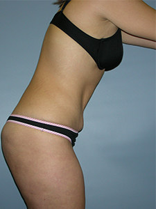 Tummy Tuck Before and After Pictures Miami, FL