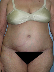 Tummy Tuck Before and After Pictures Miami, FL