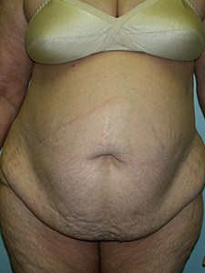 Tummy Tuck Before and After Pictures Miami, FL