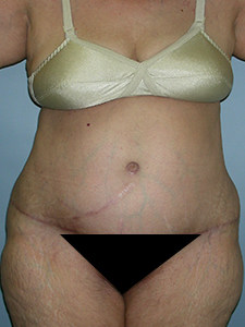 Tummy Tuck Before and After Pictures Miami, FL