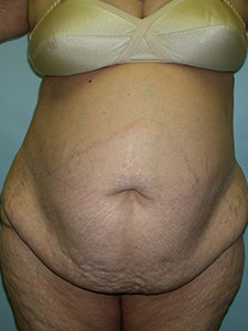 Tummy Tuck Before and After Pictures Miami, FL