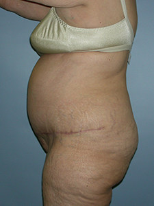 Tummy Tuck Before and After Pictures Miami, FL