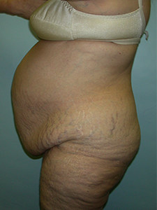 Tummy Tuck Before and After Pictures Miami, FL