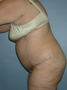 Tummy Tuck Before and After Pictures Miami, FL