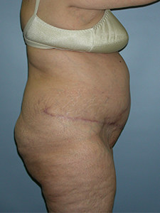 Tummy Tuck Before and After Pictures Miami, FL