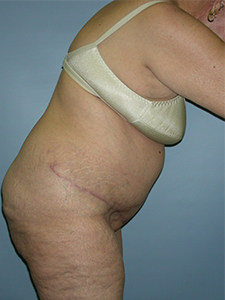 Tummy Tuck Before and After Pictures Miami, FL