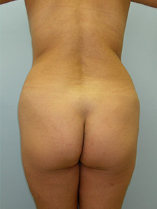 Tummy Tuck Before and After Pictures Miami, FL