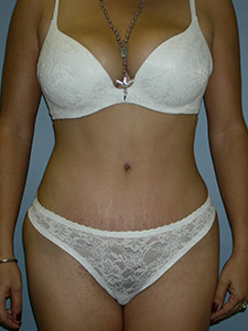 Tummy Tuck Before and After Pictures Miami, FL