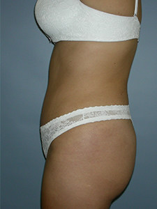 Tummy Tuck Before and After Pictures Miami, FL