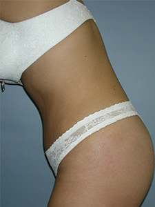 Tummy Tuck Before and After Pictures Miami, FL