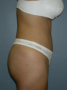 Tummy Tuck Before and After Pictures Miami, FL