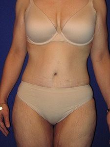 Tummy Tuck Before and After Pictures Miami, FL