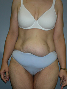 Tummy Tuck Before and After Pictures Miami, FL