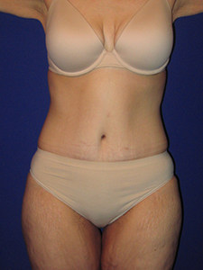 Tummy Tuck Before and After Pictures Miami, FL