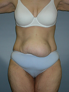 Tummy Tuck Before and After Pictures Miami, FL