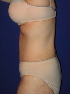 Tummy Tuck Before and After Pictures Miami, FL