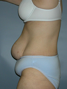 Tummy Tuck Before and After Pictures Miami, FL