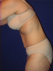 Tummy Tuck Before and After Pictures Miami, FL