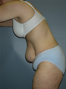 Tummy Tuck Before and After Pictures Miami, FL