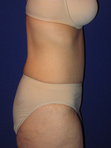 Tummy Tuck Before and After Pictures Miami, FL