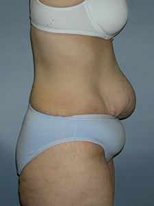 Tummy Tuck Before and After Pictures Miami, FL