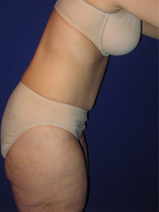 Tummy Tuck Before and After Pictures Miami, FL