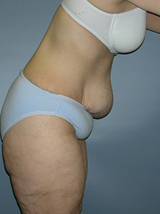 Tummy Tuck Before and After Pictures Miami, FL