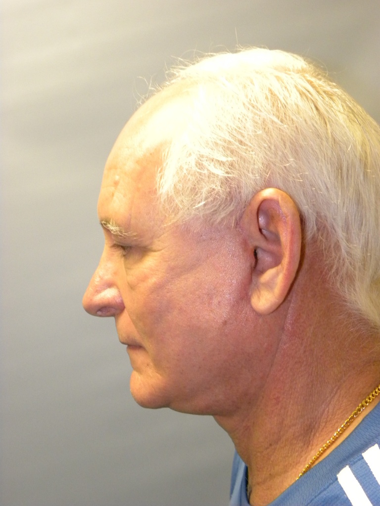 Male Facelift Before and After Pictures Miami, FL