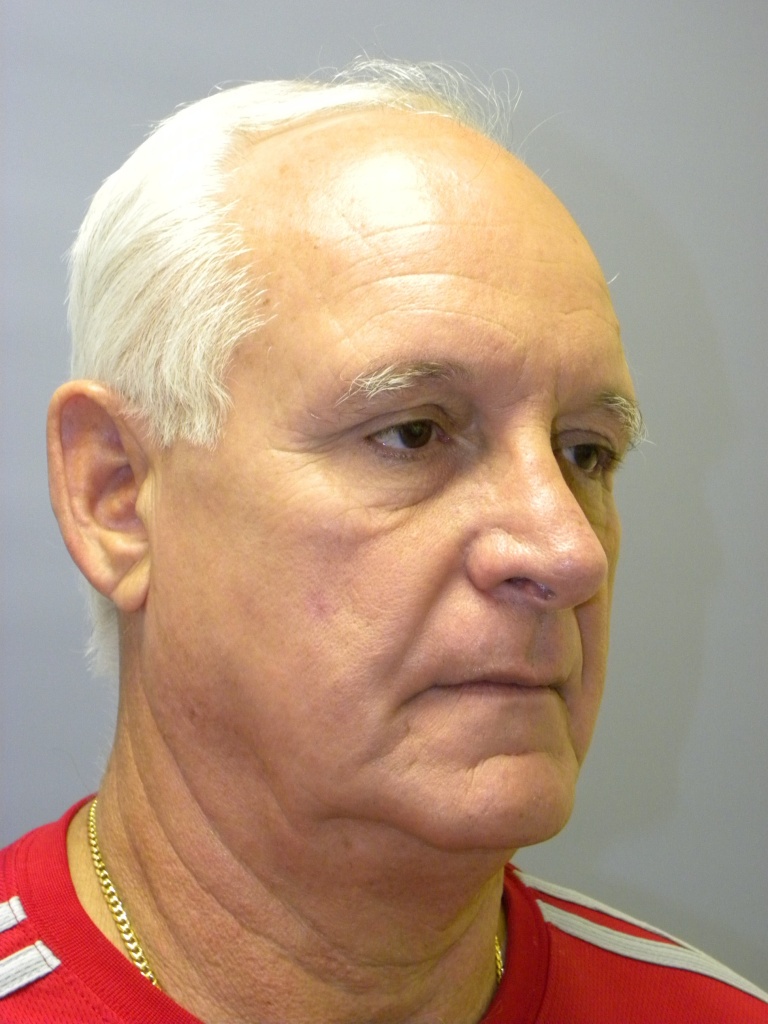 Male Facelift Before and After Pictures Miami, FL