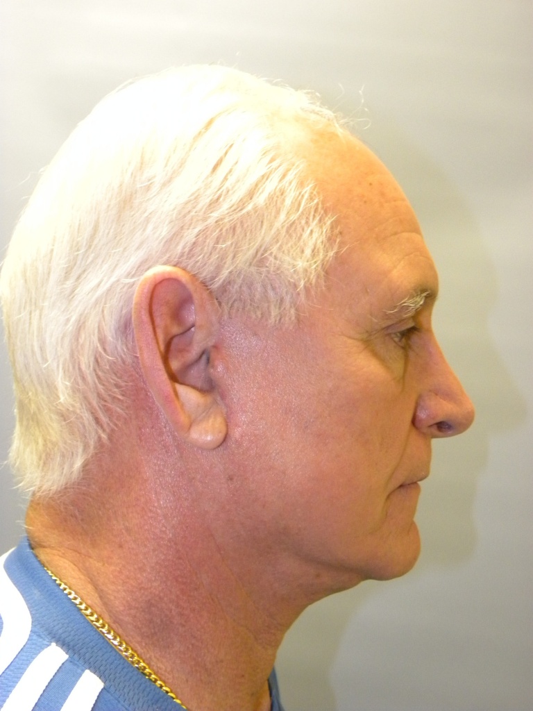 Male Facelift Before and After Pictures Miami, FL