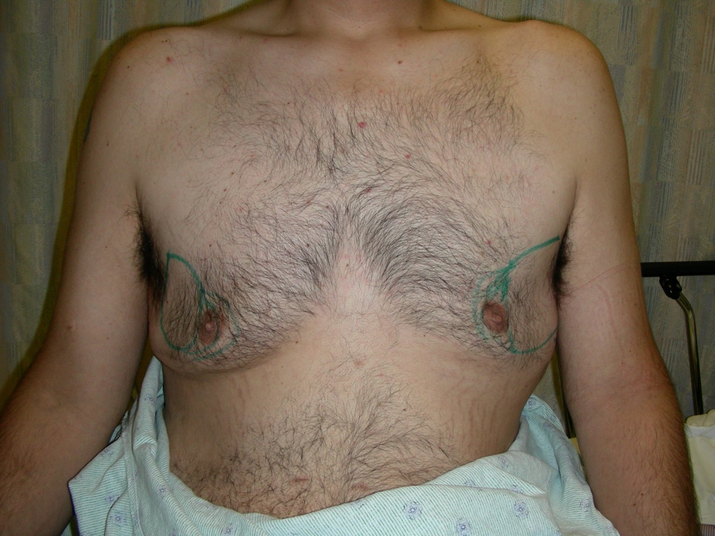 Male Fat Transfer Before and After Pictures Miami, FL