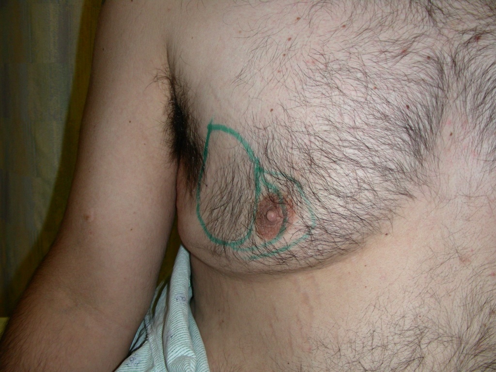 Male Fat Transfer Before and After Pictures Miami, FL