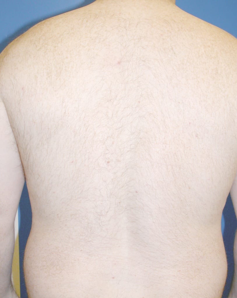 Laser Hair Removal For Men Before and After Pictures Miami, FL