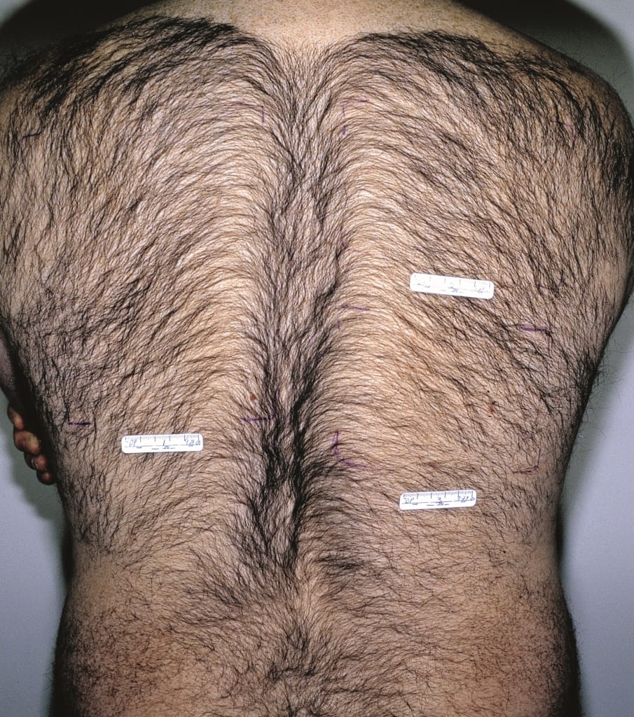 Laser Hair Removal For Men Before and After Pictures Miami, FL