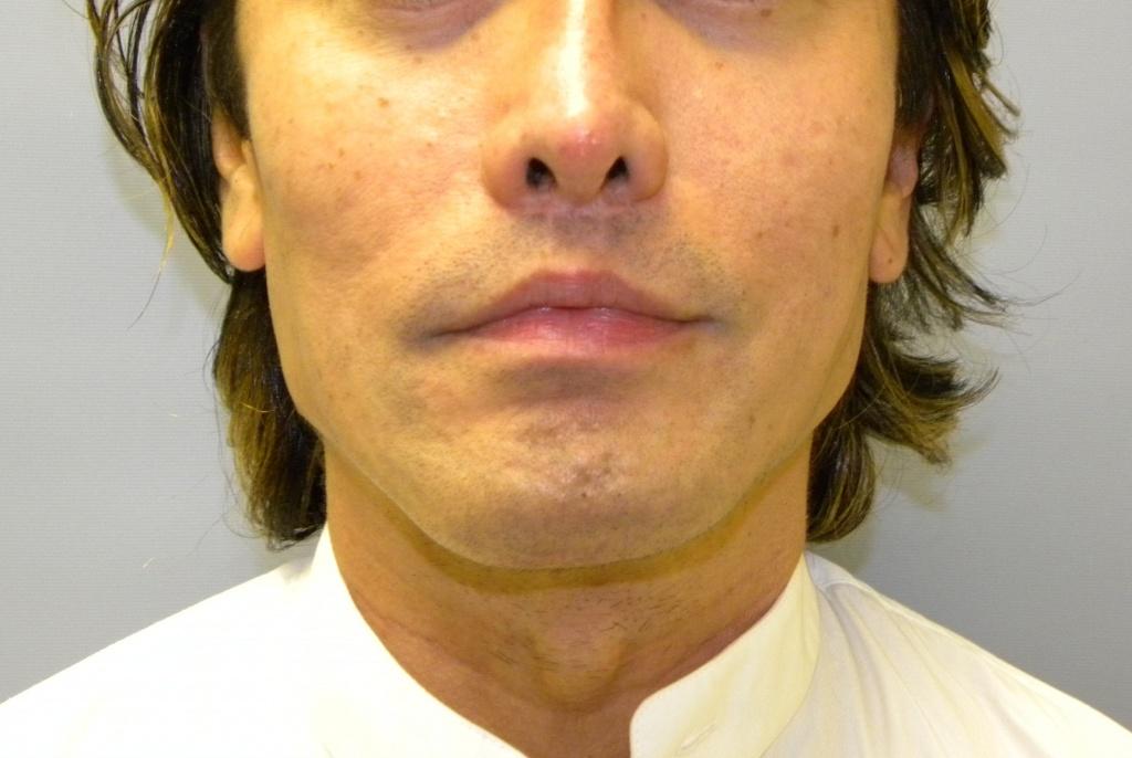 Facial Implants for Men Before and After Pictures Miami, FL
