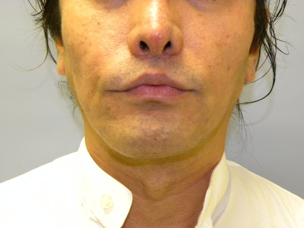 cheekbone implants men before and after