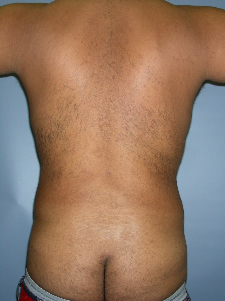 Male Liposuction Before and After Pictures Miami, FL