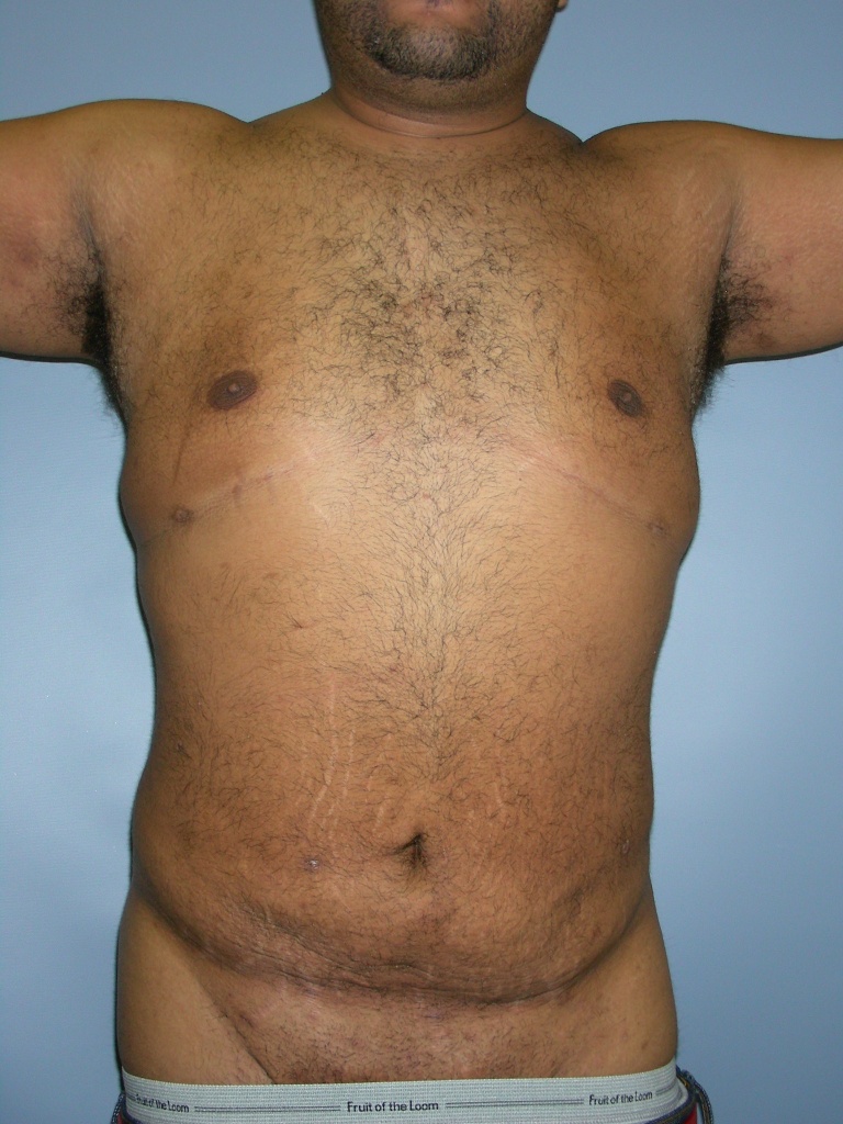 Male Liposuction Before and After Pictures Miami, FL