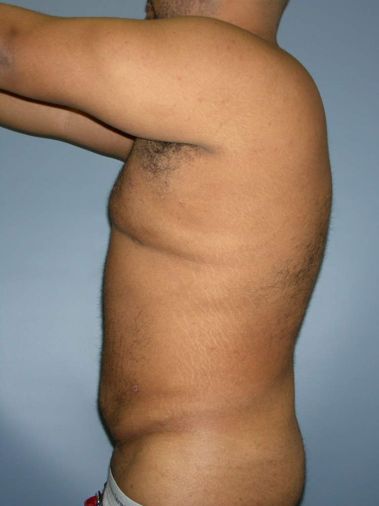 Male Liposuction Before and After Pictures Miami, FL