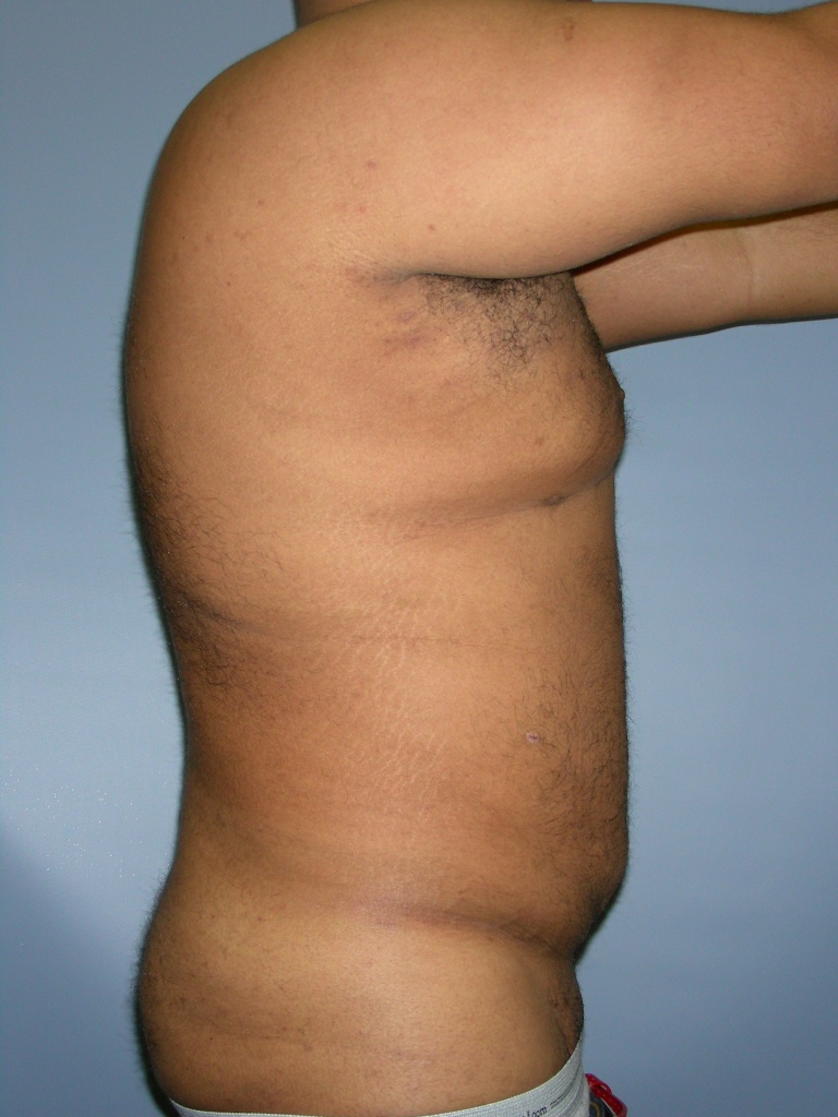 Male Liposuction Before and After Pictures Miami, FL