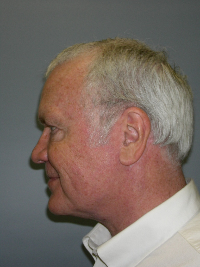 Male Neck Lift Before and After Pictures Miami, FL