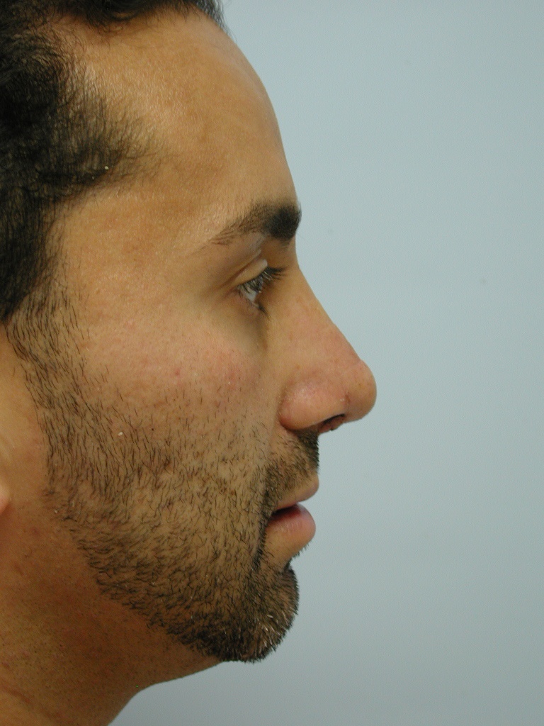 Male Rhinoplasty Before and After Pictures Miami, FL