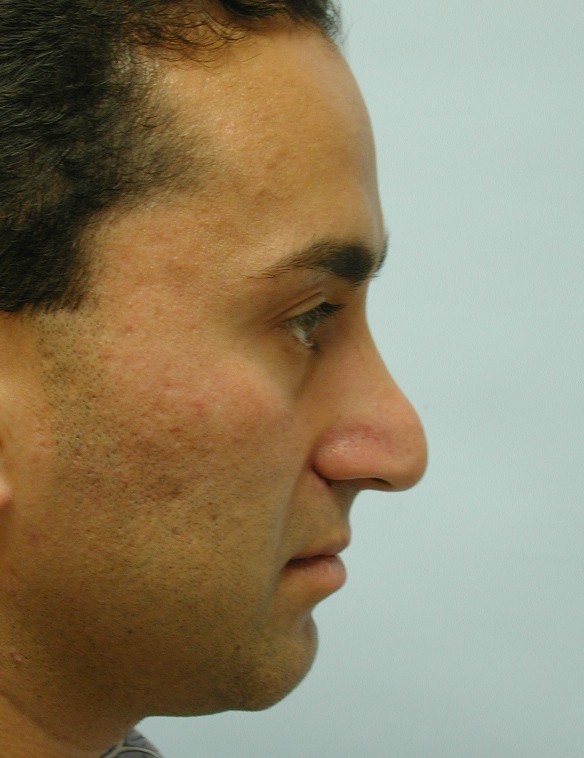 Male Rhinoplasty Before and After Pictures Miami, FL