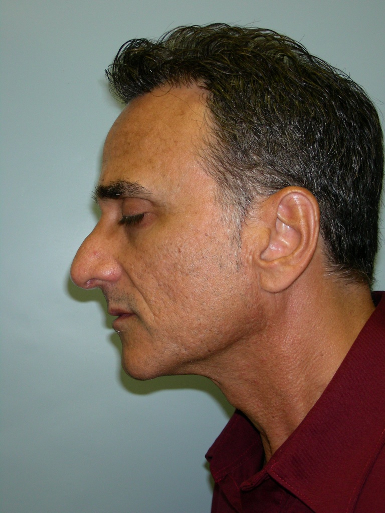 Male Rhinoplasty Before and After Pictures Miami, FL