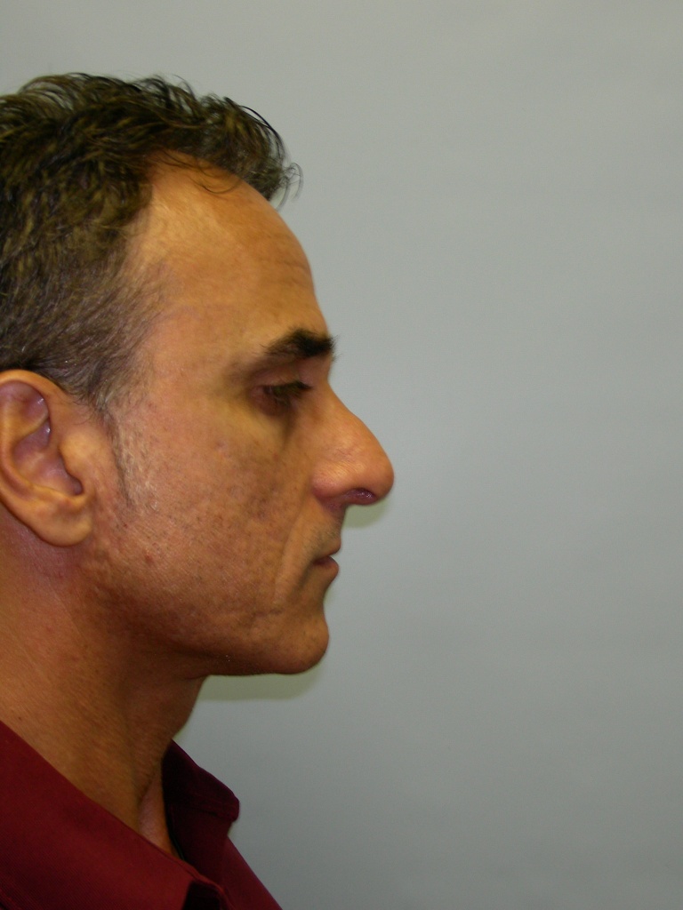 Male Rhinoplasty Before and After Pictures Miami, FL